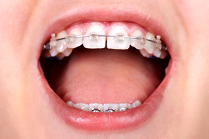 すきっ歯の原因とは？